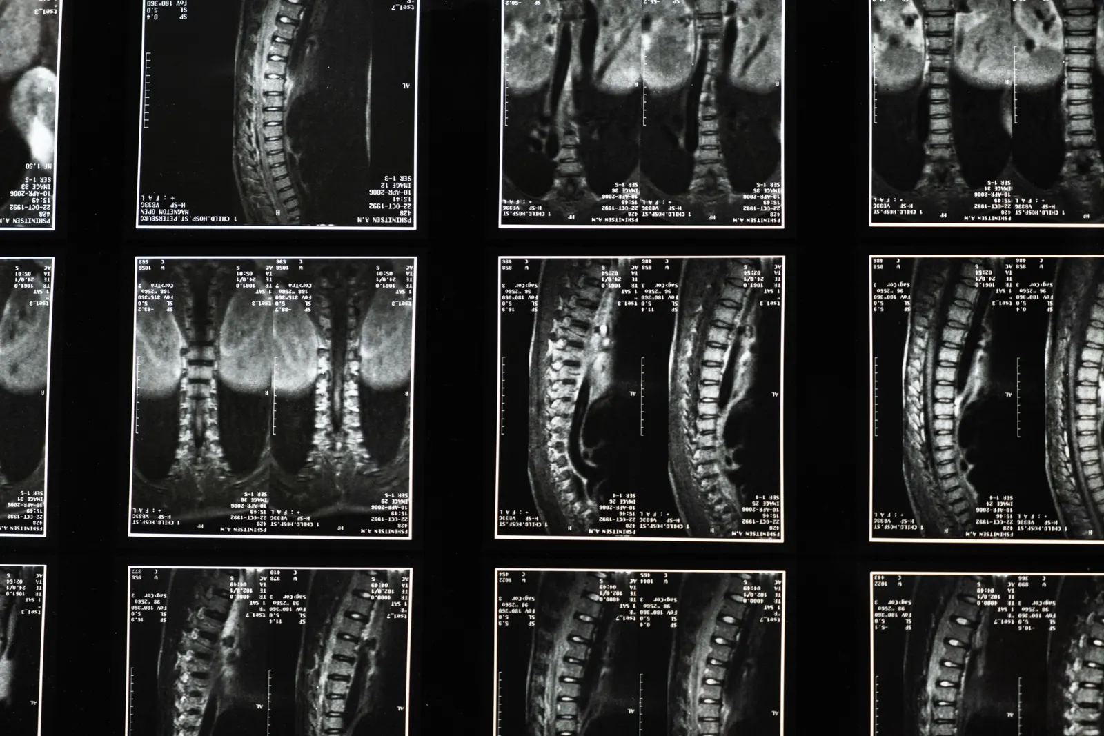 A spine x-ray image on a viewing screen.